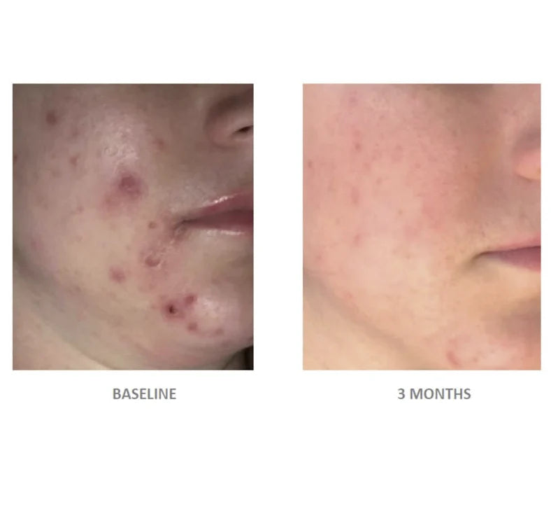 Vivier Acne Treatment Lotion