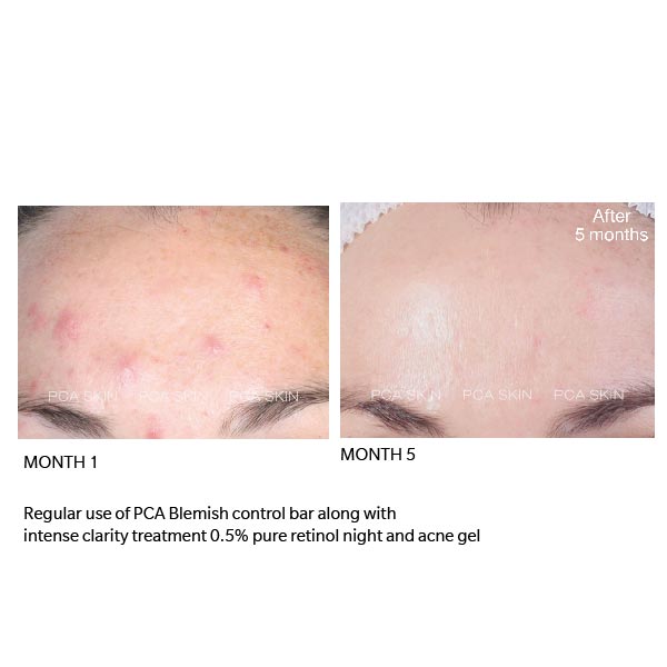 Blemish Control Bar