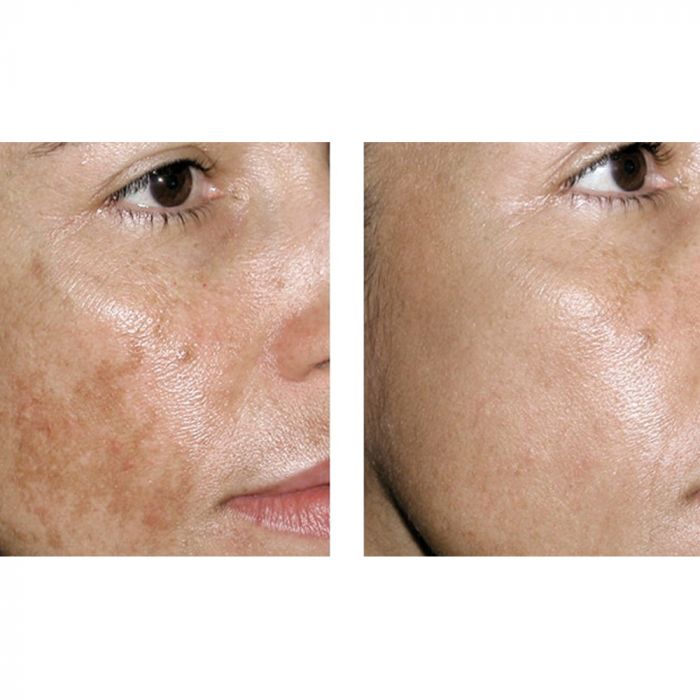 Advanced Corrector No.1