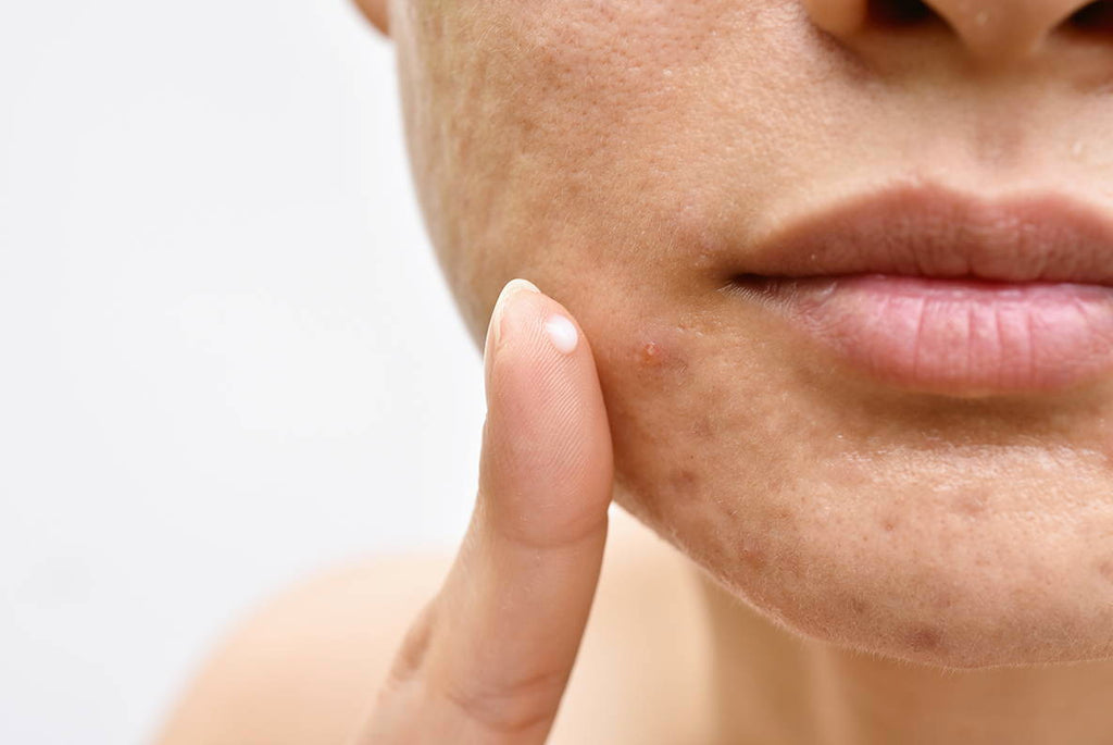 WHY ACNE IS AFFECTING YOU AND HOW TO CLEAR IT