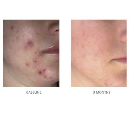 Vivier Acne Treatment Lotion